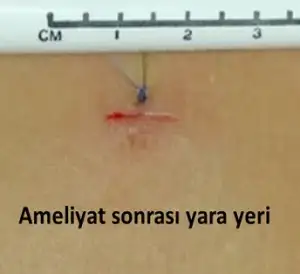 Endoskopi Yara Yeri