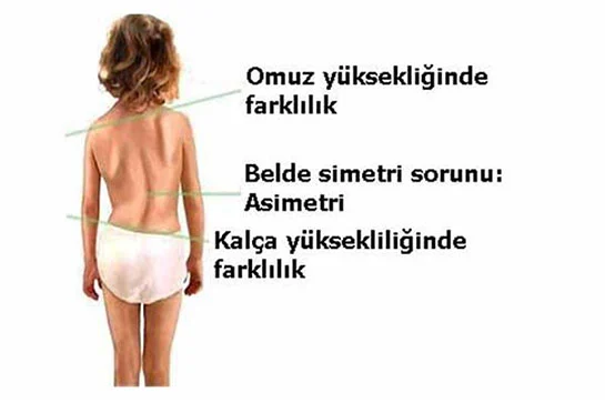 cocuklarda omurga egriligi